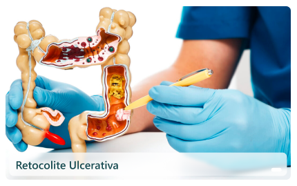 Retocolite Ulcerativa